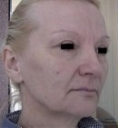 Подтяжка лица анфас — фото до операции